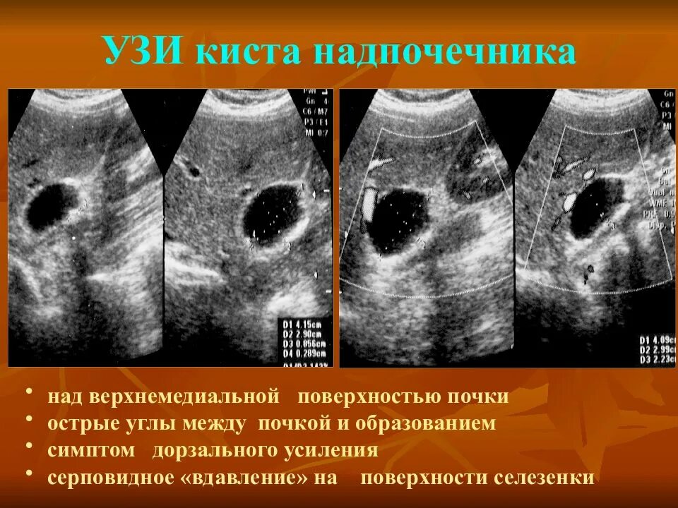 Очаговые изменения почки. Ультразвуковое исследование почек и надпочечников. Пельвикальные кисты почек на УЗИ. Надпочечники по УЗИ.