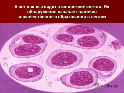 Атипичные