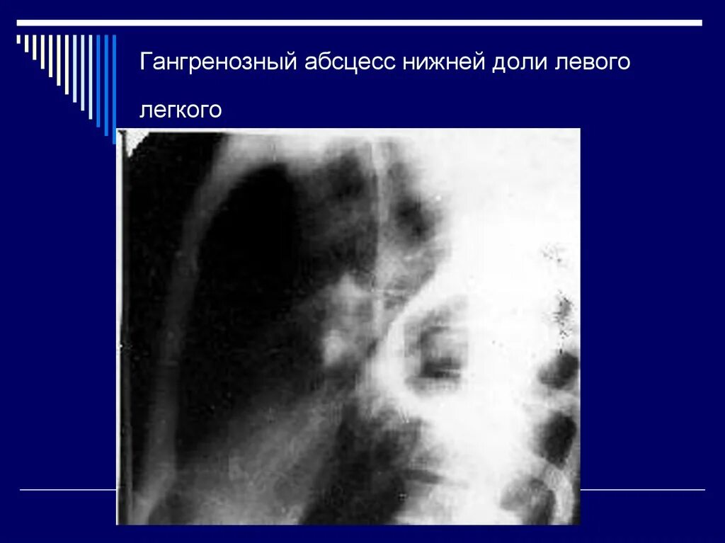 После абсцесса легкого. Гангренозный абсцесс легкого. Гангренозный абсцесс рентген. Абсцесс нижней доли левого легкого.