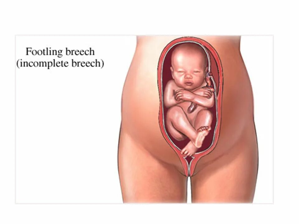 Тазовое предлежание плода УЗИ. Расположение ребенка в тазовом предлежании. Тазовое предлежание на УЗИ. Ножное предлежание плода.