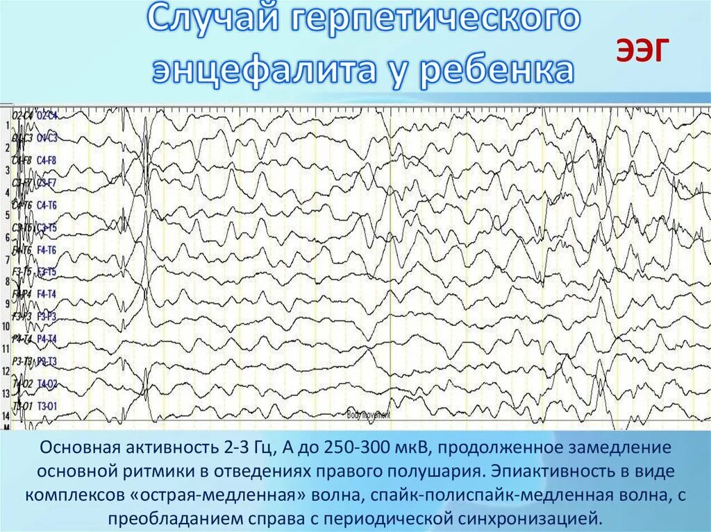 ЭЭГ при герпетическом энцефалите. ЭЭГ при некротическом энцефалите. Вертексные потенциалы на ЭЭГ. Эпиактивность на ЭЭГ. Медленные волны на ээг