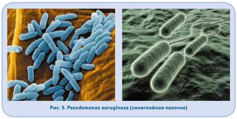 Гнойная бактерия. Синегнойная палочка псевдомоноз. Синегнойная палочка микрофотография. Бактериальная инфекция (синегнойная палочка). Раневая инфекция синегнойная палочка.