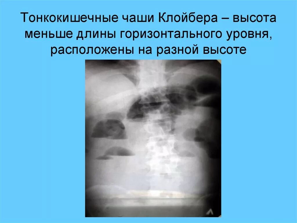 Уровень на рентгене