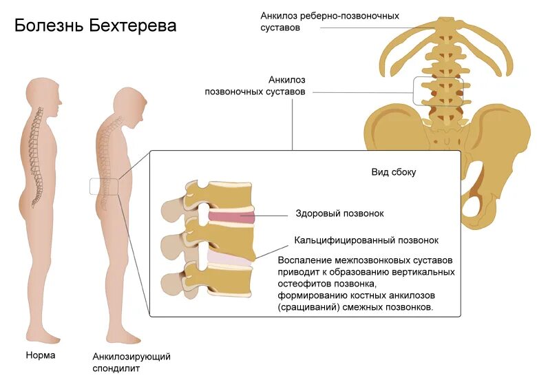 Боль в пояснице причины и лечение. Анкилозирующий спондилоартрит болезнь Бехтерева. Болезнь Бехтерева поясничный отдел позвоночника. Анкилозирующий спондилит болезнь Бехтерева. Болезнь Бехтерева или анкилозирующий спондилоартрит;.