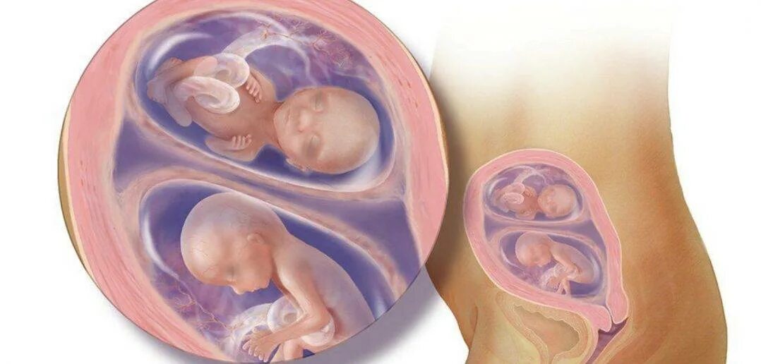 Многоплодная беременность беременность двойней. Многоплодие при беременности. 18 неделя близнецов