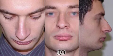 Упала носом