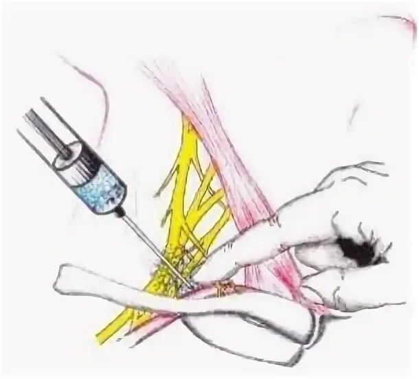 Блокада сплетения. Проводниковая блокада плечевого сплетения по Куленкампфу. Куленкампфу анестезия плечевого сплетения. Проводниковая анестезия по Куленкампфу. Блокада плечевого сплетения по Куленкампфу техника.
