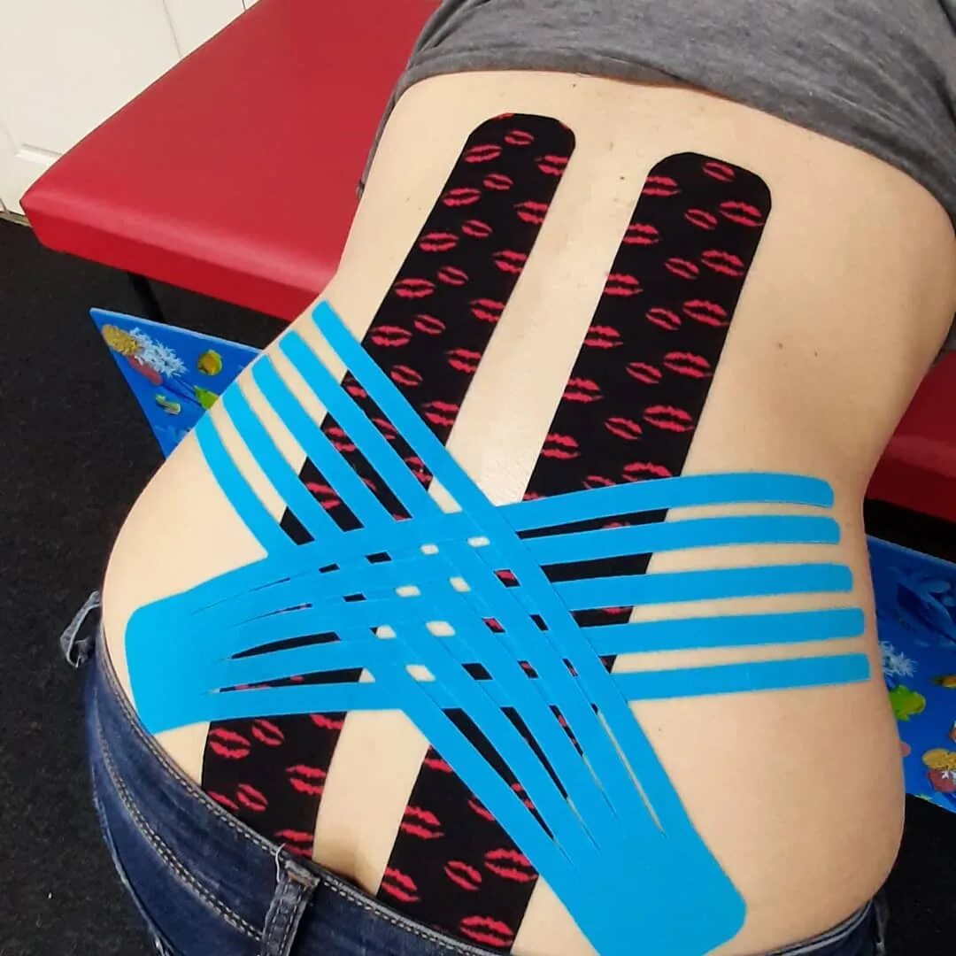 кинезио тейп на поясничный отдел. тейпирование пояснично-крестцового отдела позвоночника. тейпирование поясничного отдела позвоночника. тейп на крестец. тейпирование акс.