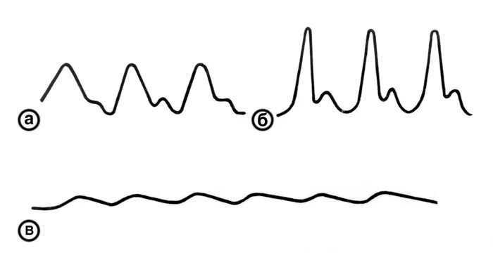 Графическое изображение пульса. Сфигмограмма нитевидного пульса. Частый нитевидный пульс. Патологические формы пульса сфигмограмма.