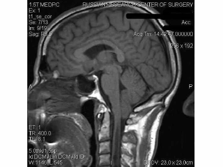 Аномалия арнольда киари что это простыми. Аномалия Арнольда Киари 1 типа мрт головного мозга. Мальформация Арнольда-Киари мрт. Аномалия Киари 1 типа на мрт. Сирингомиелия Арнольда Киари 2.
