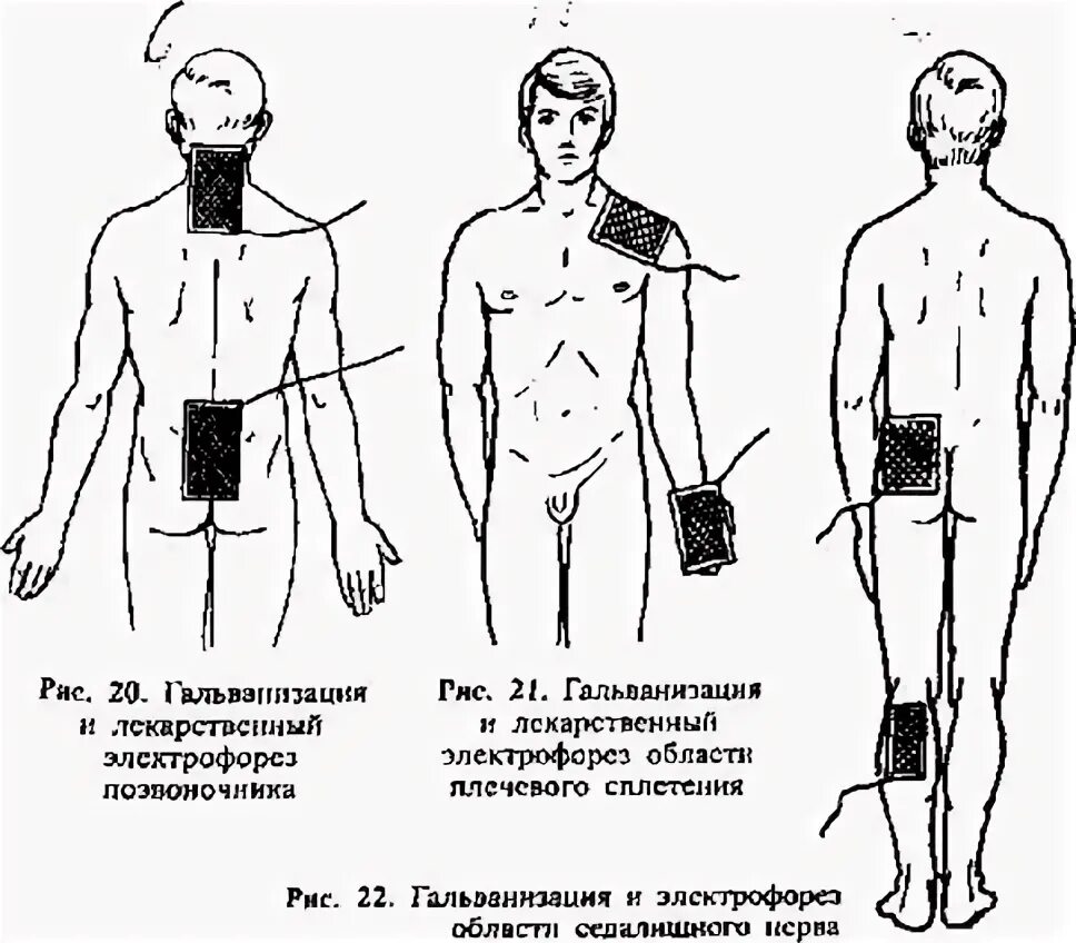 Электрофорез с эуфиллином на отдел позвоночника. Электрофорез методики наложения электродов. Электрофорез накладывание электродов. Методика наложения электродов при электрофорезе. Гальванизация методики наложения электродов.