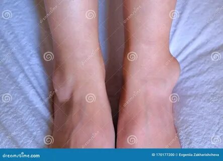 Отекают вечером щиколотки