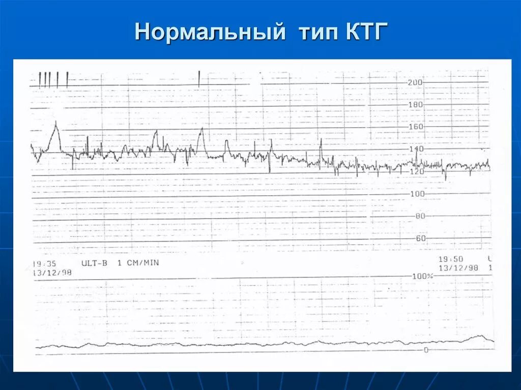 Нормальное ктг