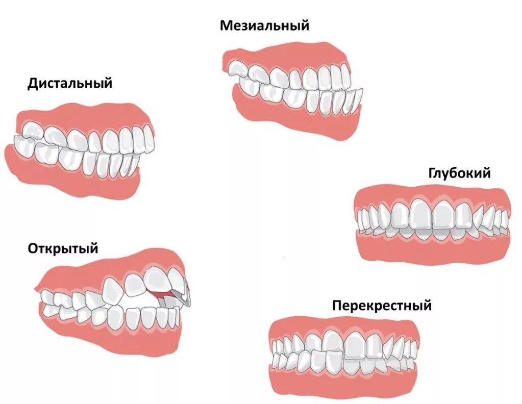 Как понять прикус. Правильный прикус и неправильный прикус. типы прикусов зубов у человека. правильный прикус вид сбоку. прикус зубов правильный и неправильный у детей 4-5 лет.