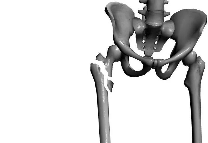 Переломы шейки бедра классификация рентген. Чрезвертельный перелом бедра рентген. Перелом бедра со смещением у пожилых. Перелом головки бедренной кости рентген. Перелом шейки бедра памятка.