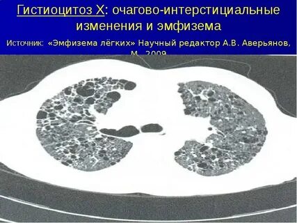 Изменения в легких на кт