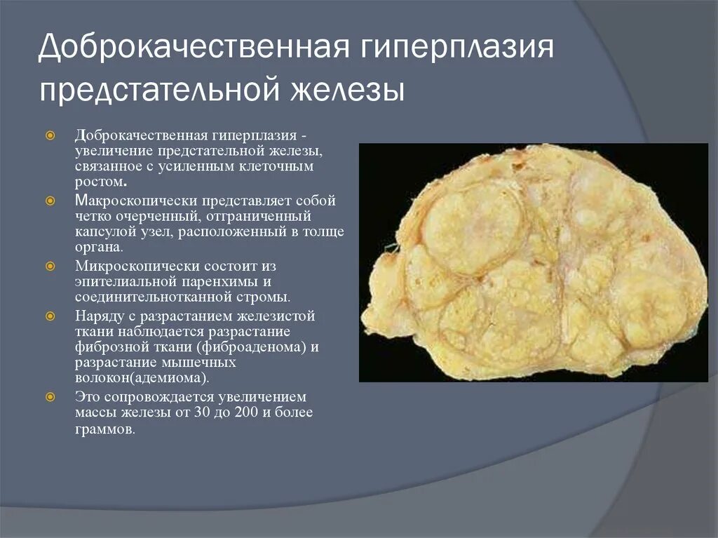 Стадии дгпж. Доброкачественная Узловая гиперплазия предстательной железы. Доброкачественная нодулярная гиперплазия предстательной железы. Фиброзно мышечная гиперплазия предстательной железы. Дисгормональная гиперплазия предстательной железы макропрепарат.