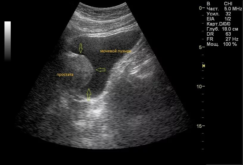 Дгпж узи. УЗИ предстательной железы трансабдоминально. Аденома предстательной железы на УЗИ трансабдоминально. УЗИ мочевого пузыря аденома. УЗИ трузи предстательной железы.