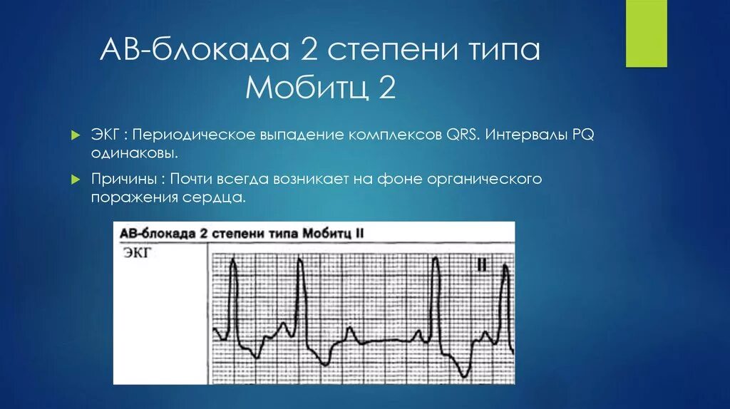 Давление блокада. Av блокада 2 степени Мобитц 2 на ЭКГ. АВ блокада 2 степени типа Мобитц 2. АВ блокада 2 Мобитц 1 на ЭКГ. Атриовентрикулярная блокада Мобиц 1 ЭКГ.