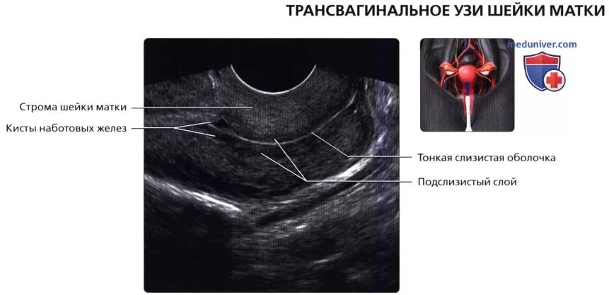 Можно на узи увидеть рак шейки матки. Кисты наботовых желез на УЗИ. Киста наботовых желез шейки матки.