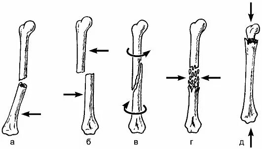 5 групп костей. Поперечный оскольчатый перелом. Поперечные косые винтообразные переломы. Винтообразный перелом голени. Поперечный перелом трубчатой кости.