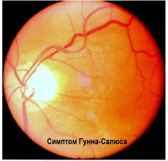 Гипертоническая ретинопатия глазное дно. Гипертоническая ретинопатия Салюс. Гипертоническая ангиопатия глазное дно. Центральная серозная ретинопатия.
