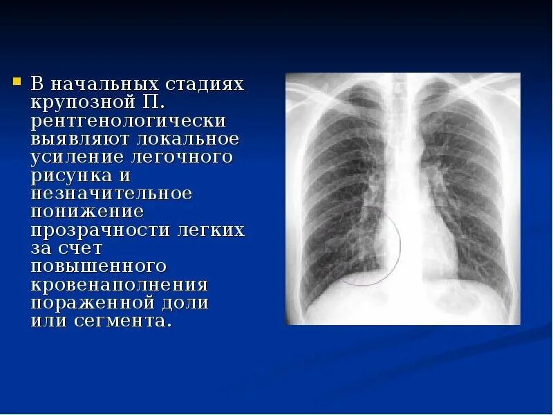 Легочный рисунок смешанного типа