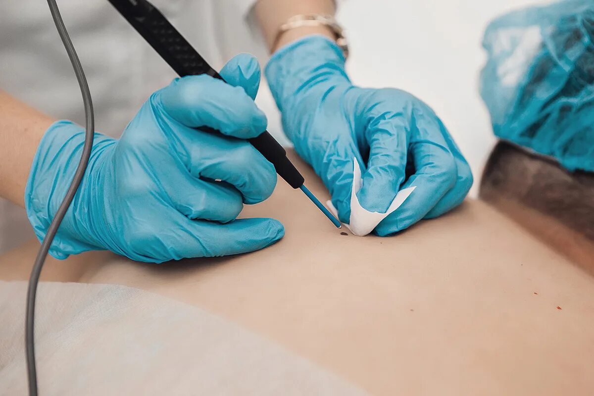 Удаление радиоволновым методом. Удаление радиоволновым методом. Удаление радиоволновым методом. Аппарат радиоволновой терапии. Сургитрон аппарат.