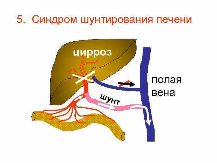 Синдром шунтирования печени. Синдром портокавального шунтирования. Шунтирование портальной вены.