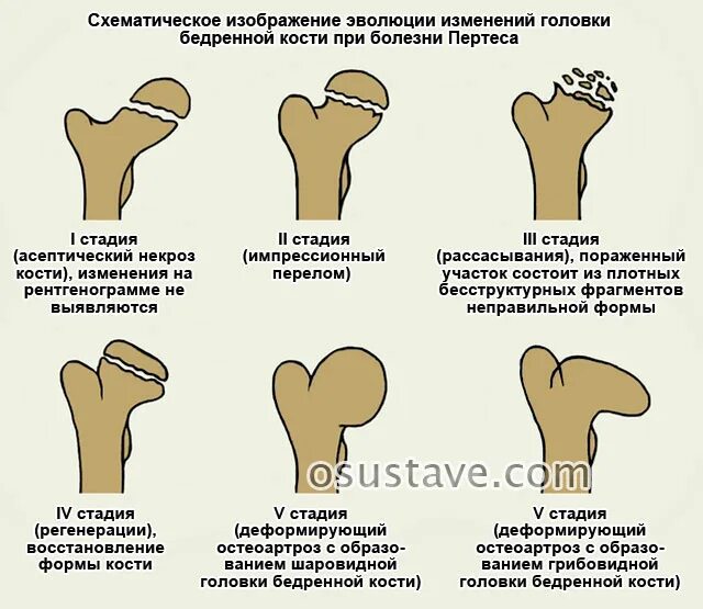 Боли при некрозе тазобедренных суставов