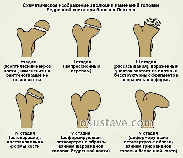 Остеохондропатия головки бедра – болезнь Легга-Кальве-Пертеса.. Грибовидная деформация головки тазобедренного сустава. Болезнь Легга Кальве Пертеса стадии. Болезнь Легга Кальве Пертеса стадия асептического некроза. Изменение формы кости