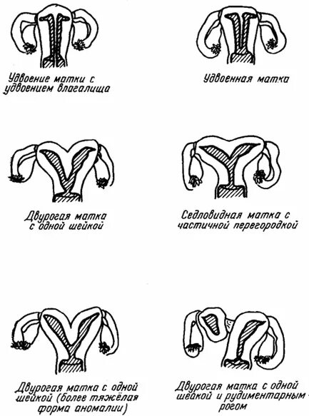 Классификация седловидной матки. Аномалия развития матки двурогая матка. Аномалия развития матки (седловидная форма u2acovo по версии ESHRE). Аномалия развития шейки матки удвоение.