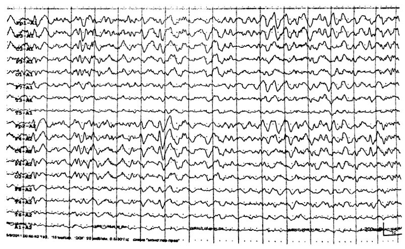 Ээг хабаровск. Дельта ритм на ЭЭГ У взрослых. Альфа ритм на ЭЭГ норма. Амплитуда ЭЭГ. ЭЭГ ритмы таблица.
