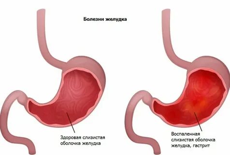 Обострение гастрита желудка