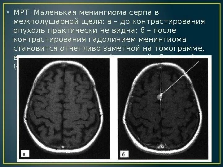 Межполушарная щель головного мозга. Липома мозолистого тела кт. Менингиома головного мозга кт. Поперечный срез головного мозга мозга. Межполушарная щель головного мозга.