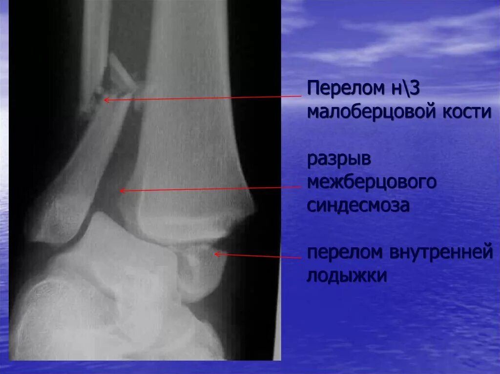 Перелом метаэпифиза малоберцовой кости. Краевой перелом малоберцовой кости. Разрыв дистального межберцового синдесмоза рентген. Перелом н 3