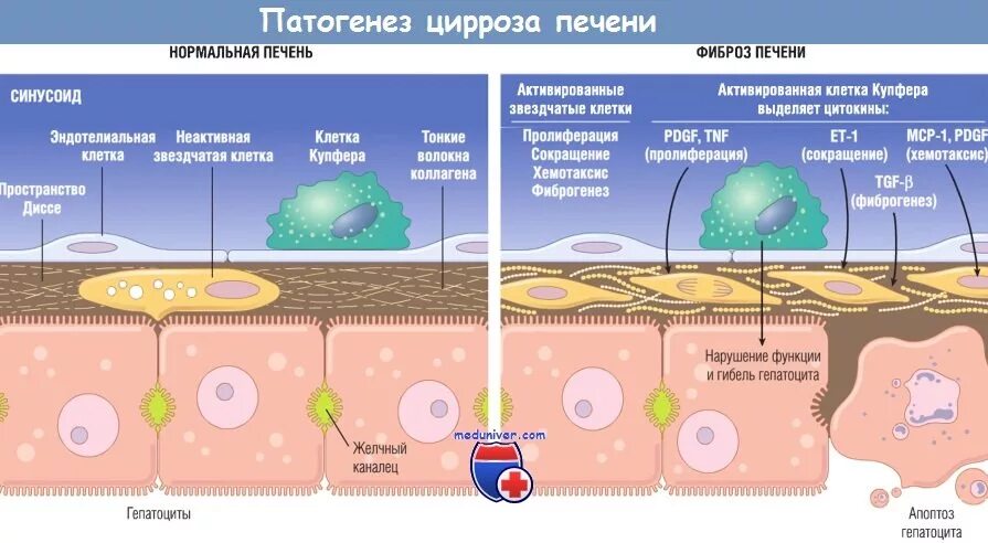 Фиброз печени 4 степени сколько. Механизмы развития фиброза печени. патогенез фиброза печени. патогенез цирроза.