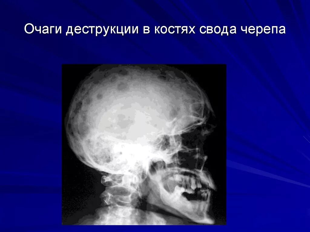 Вторичное поражение костей. Метастазы в кости черепа на рентгене. Деструкция костей миеломная болезнь. Миеломная болезнь кости черепа. Остеопороз костей свода черепа.