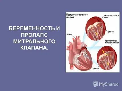 Пролапс задней стенки
