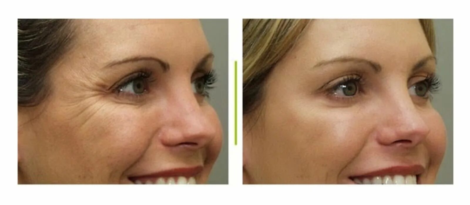 Ботокс в гусиные лапки до и после. Ботокс вокруг глаз. Ботокс от гусиных лапок до и после. Диспорт для лица гусиные лапки. Ботокс вокруг глаз.