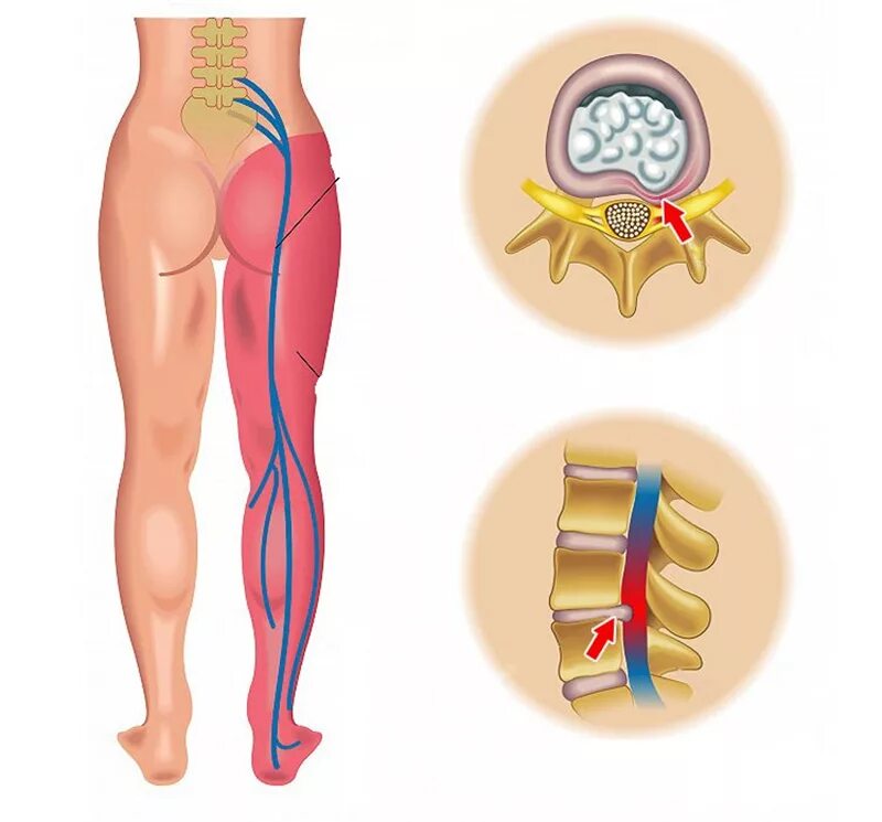 Как уменьшить поясничную грыжу. Комплекс упражнений для спины при грыже в поясничном отделе. Гимнастика для спины при остеохондрозе поясничного отдела при болях. Как уменьшить поясничную грыжу. Межпозвоночная грыжа.