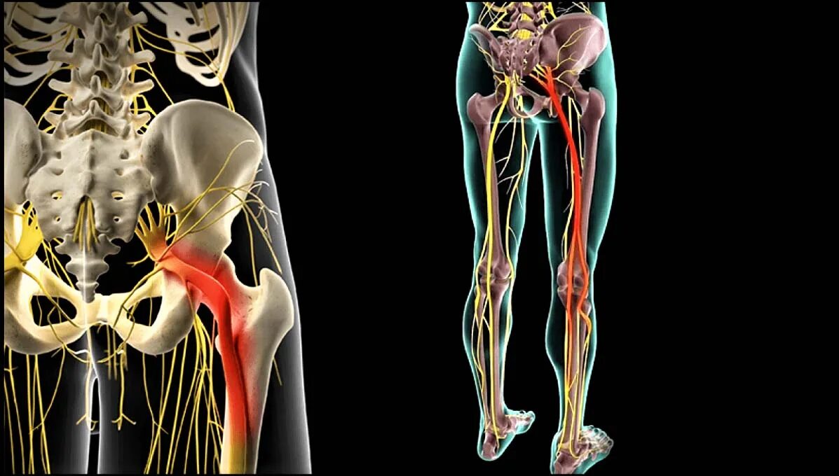 Седалищный нерв (sciatic nerve)? 011. Защемление седалищного нерва анатомия. Защемление седалищного нерва s1. Защемление нерва ишиас.