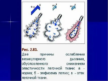 Аускультация при эмфиземе