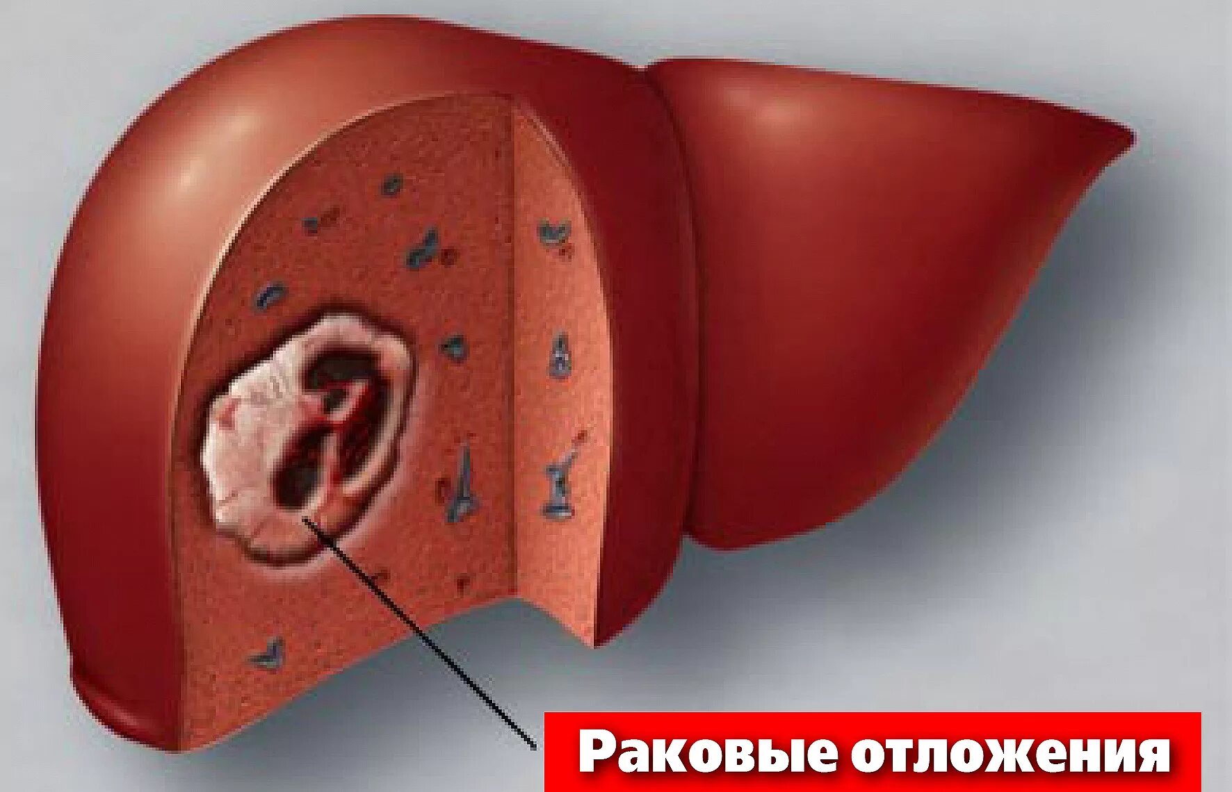 Злокачественные новообразования печени. Объемные образования печени. Объемного образования печен. 2 опухоли в печени. Гепатоцеллюлярная карцинома печени.
