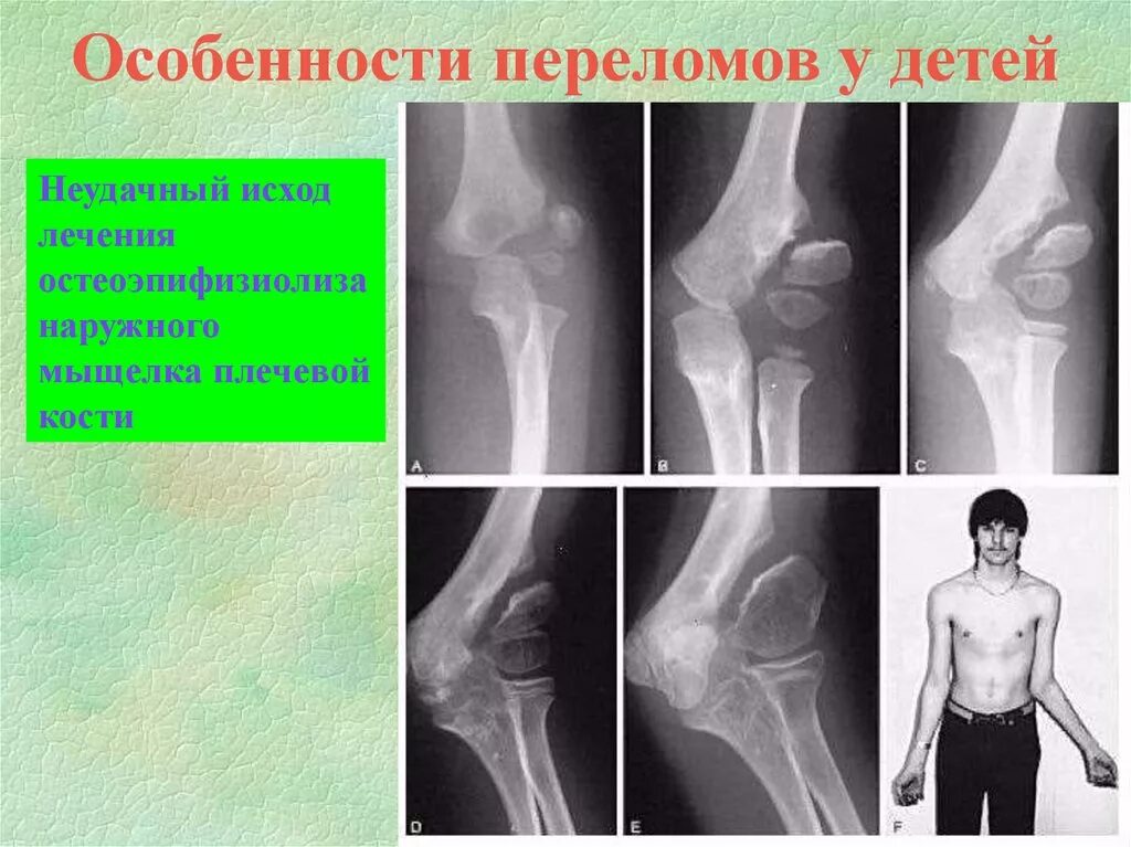 Причины переломов костей конечностей