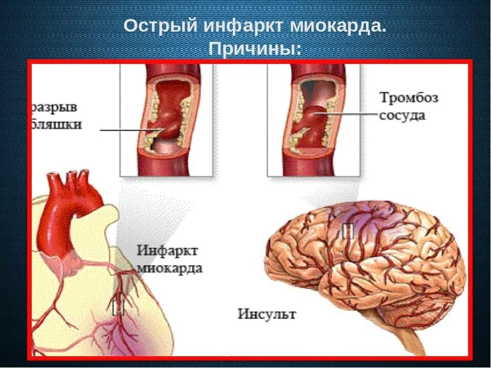 Сердечная недостаточность при инфаркте миокарда. Острой сердечной недостаточности и инсульте. Острая сердечная недостаточность инфаркт миокарда.