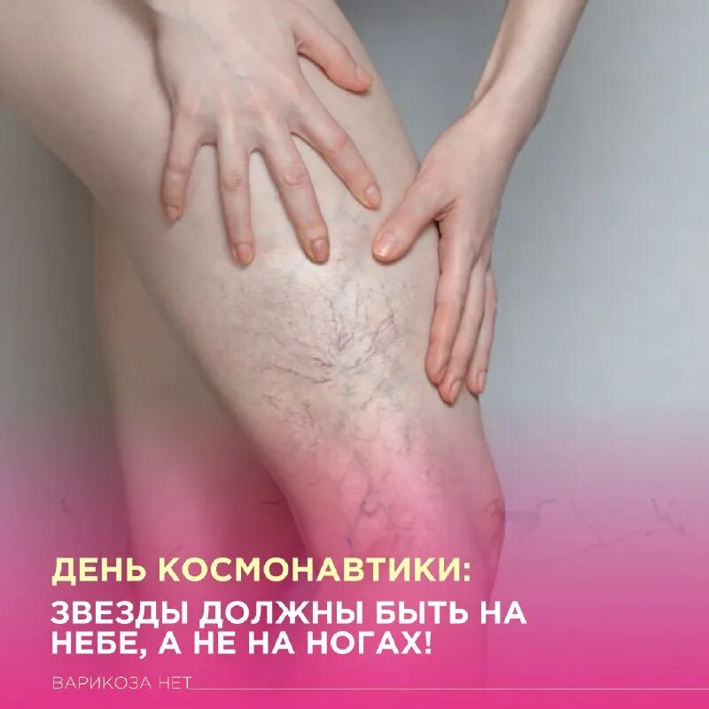 свободы 125 варикоза нет