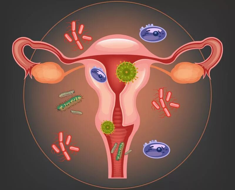Микроорганизмы женских половых органов. Воспалительные гинекологические заболевания. Болезни репродуктивной системы. Патологии женской репродуктивной системы. Заболевания репродуктивной системы у женщин.