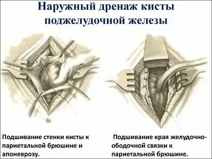 Дренаж что это операция