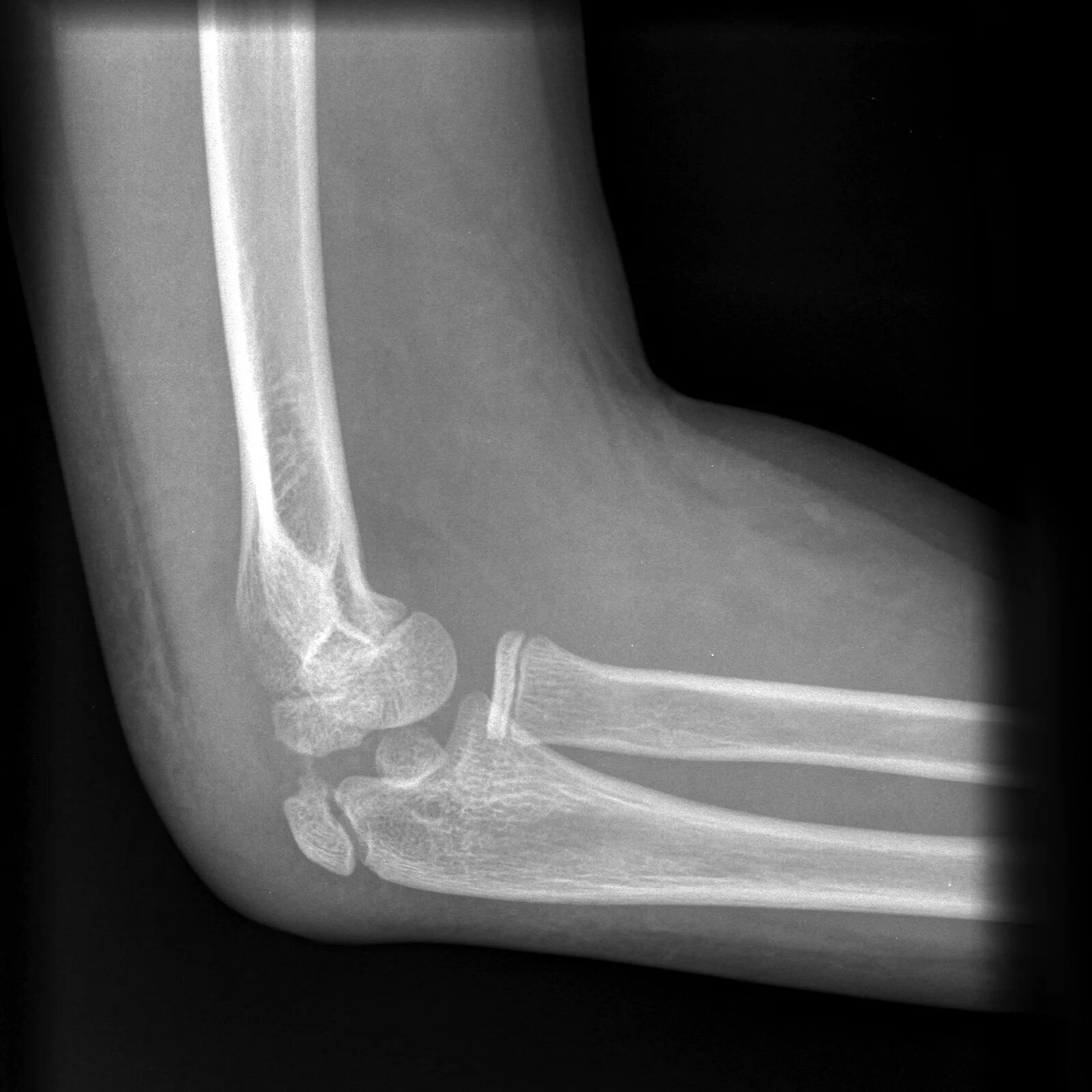 Перелом локтевой кости рентген. Перелом локтевого отростка локтевого сустава. Оскольчатый перелом локтевого отростка. Чрезмыщелковый перелом локтевого сустава.